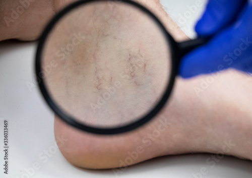 A man in consultation with a vascular surgeon. A doctor examines a leg with swollen veins. Varicose veins on the leg