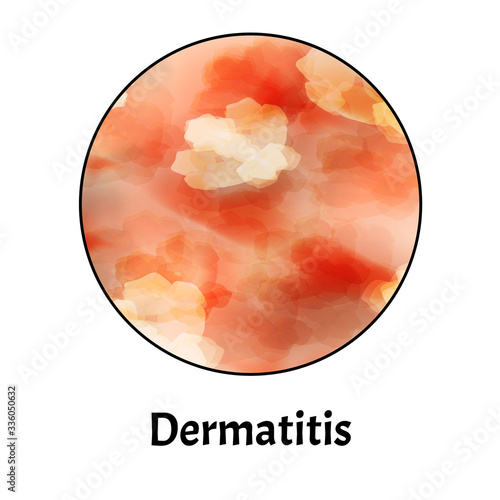 Skin inflammation. Dermatitis skin. Infographics. Vector illustration on isolated background.