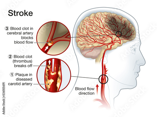 Stroke, medically accurate illustration photo