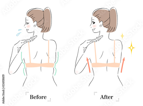 背中　はみ肉　脂肪　ビフォーアフター　女性