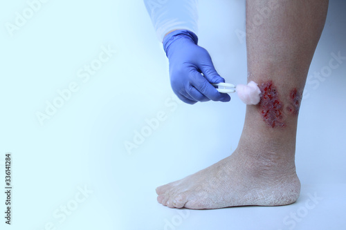 close-up nurse treats a wound on the ankle of the foot with damage to the epidermis, medical concept for the treatment of trophic ulcers photo