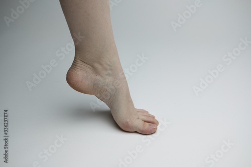 close up of a woman arching her foot with bruising, veins, and broken toenail
