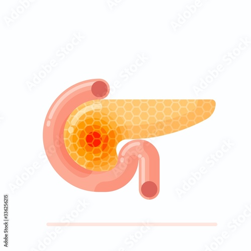 Illustration showing sick human pancreas, concept of human pancreatitis and cancer, flat design vector illustration