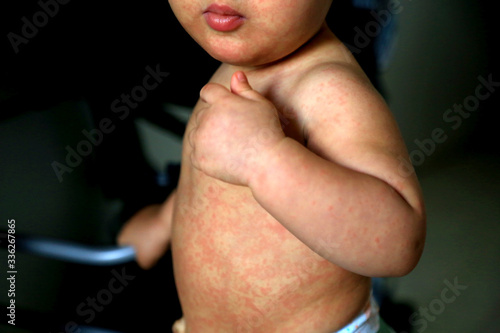 Child with measles symptoms photo