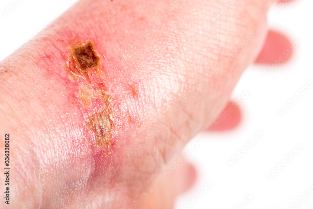 chemical burn on the wrist skin with hydroxide sodium acid, by striping paint from wood furniture. Household accident, because of gloves to sharp chemical burn on the wrist skin with hydroxide sodium acid, by striping paint from wood furniture. Household accident, because of gloves to sharp