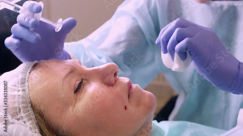 Middle aged woman 50 getting a lifting injection of an injection of hyaluronic acid into the face by a doctor cosmetologist. Cosmetic procedure. photo