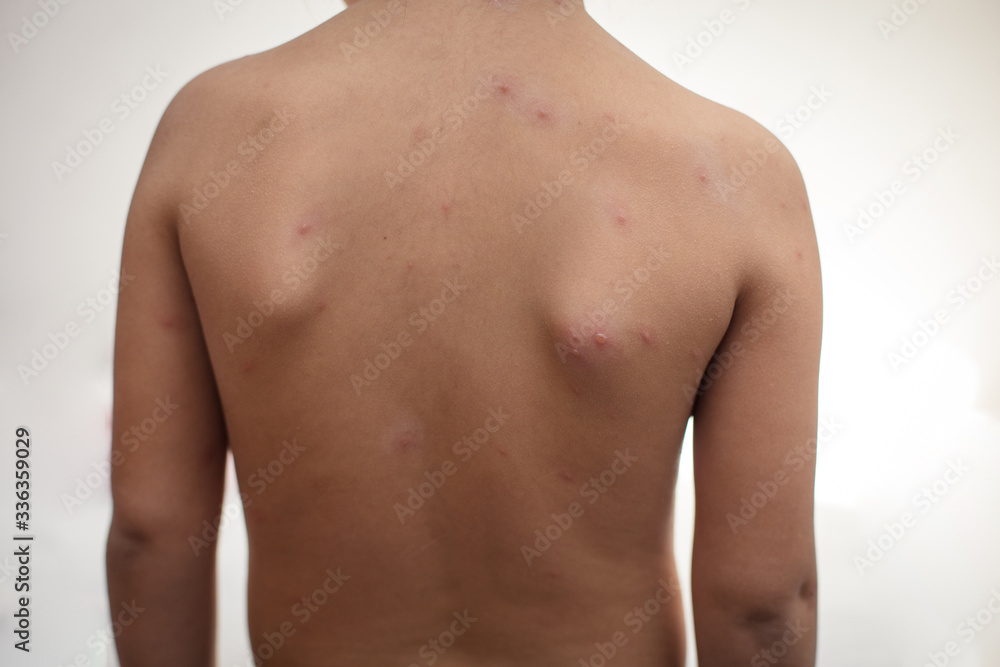 Impaired immunity brings about various diseases. Impaired immunity brings about various diseases.