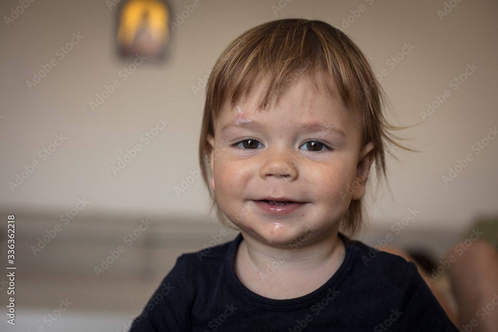 He is sweet with smallpox in the skin. He is sweet with smallpox in the skin.