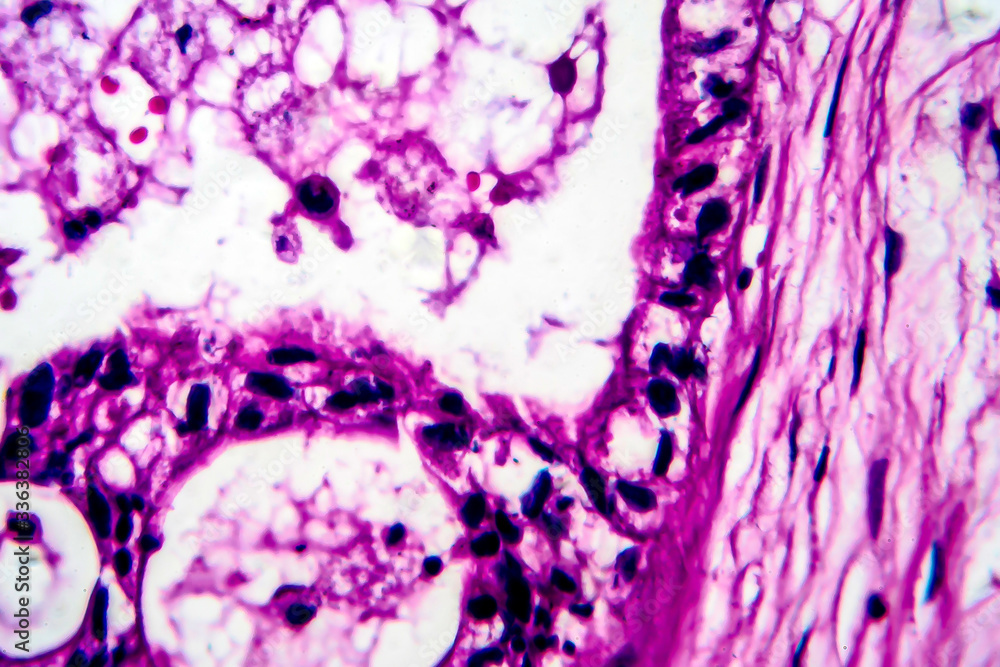 Uterine cancer, light micrograph, photo under microscope