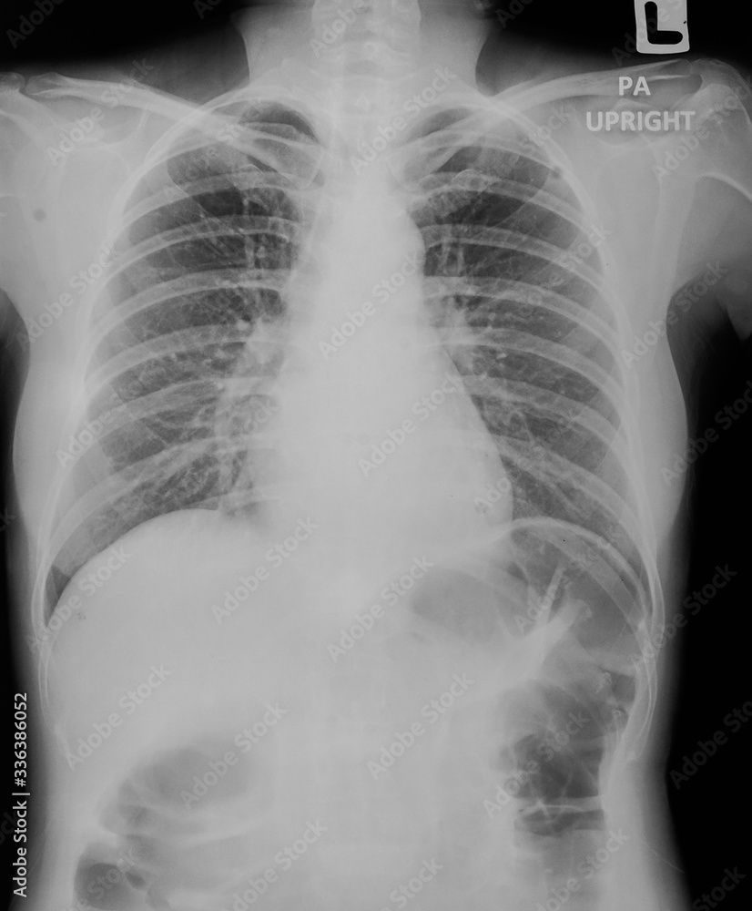 Film of abdomen series X ray of abdomen. Film of abdomen series X ray of abdomen.