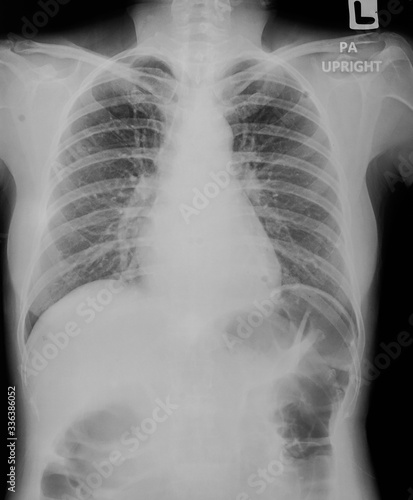 Film of abdomen series X ray of abdomen.