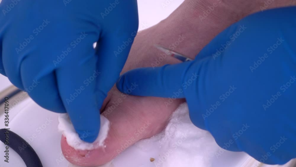 Step-by-step shooting. Surgery at home in connection with quarantine and self-isolation. Removing ingrown under skin of nail. concept of social problems and protective equipment. Coronavirus epidemic Step-by-step shooting. Surgery at home in connection with quarantine and self-isolation. Removing ingrown under skin of nail. concept of social problems and protective equipment. Coronavirus epidemic