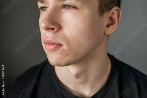 Young man struggling with acne on his face caring for his skin pushes acne photo