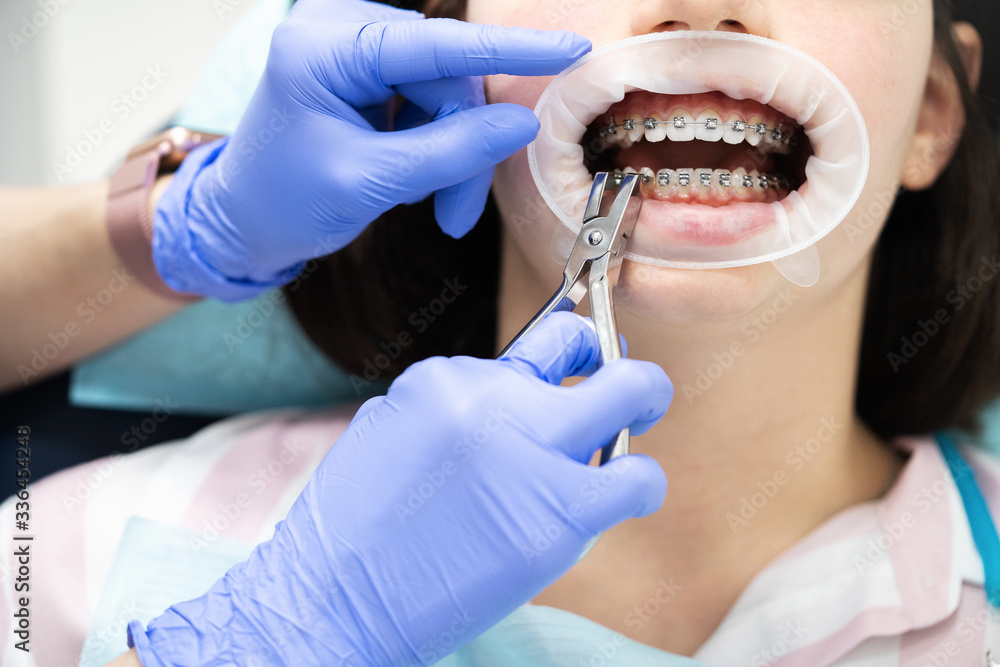Dentist patient with open mouth and rubber retainer. Braces maintenance procedure, cleaning and