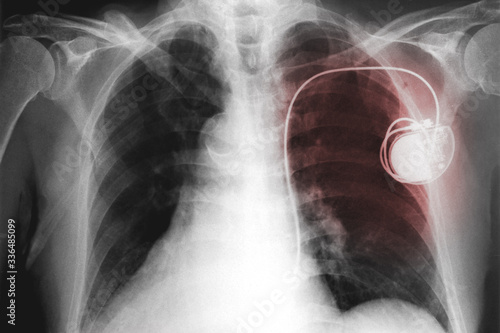 Tableau sur toile xray film image of chest with the pacemaker