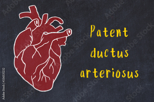 Chalk sketch of human heart on black desc and inscription Patent ductus arteriosus photo