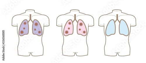 コロナウイルス・肺の断面図