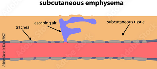 subcutaneous emphysema close up lung