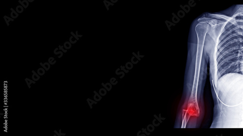Film X-ray elbow radiograph show elbow dislocation. The patient has joint dislocation injury from traffic accident. Red highlight on dislocate site and painful area. Medical Xray and radiology concept photo