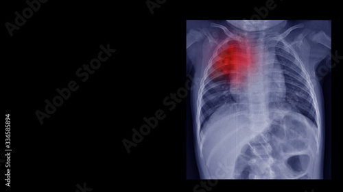 Film chest  X ray radiograph show  infiltration at upper lobe. This cause form pneumonia, pulmonary tuberculosis (TB), viral infection, restrictive lung disease, cancer (CA). Medical imaging concept  photo
