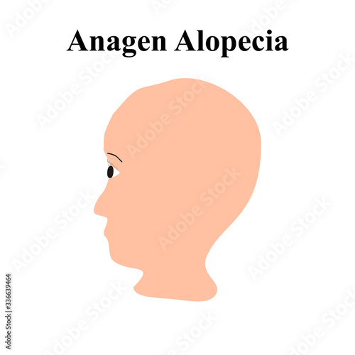 Alopecia hair. Baldness of hair on the head. Anagen Alopecia. Infographics. Vector illustration on isolated background.