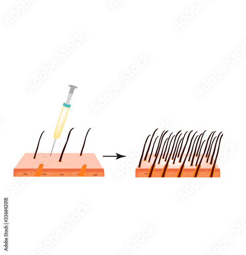 Treatment of alopecia. Bald spot, baldness, Alopecia mesotherapy. Infographics. Vector illustration on isolated background.