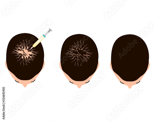 Treatment of alopecia. Bald spot, baldness, Alopecia mesotherapy. Infographics. Vector illustration on isolated background.