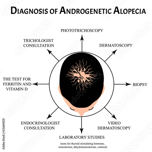 Diagnosis of alopecia. Bald spot, baldness, Alopecia mesotherapy. Infographics. Vector illustration on isolated background.