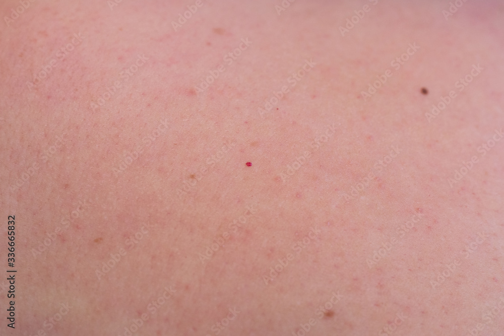 Woman with birthmarks on her skin Woman with birthmarks on her skin