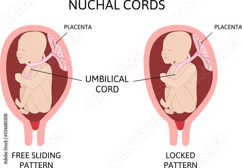 Umbilical Cord around Neck. Nuchal cord. two loopes is on the child's neck.