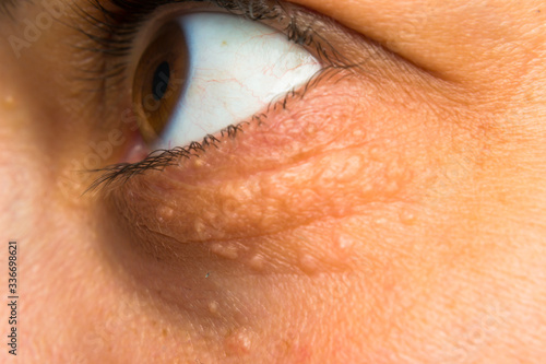 close-up photo of a women face with fat points near eye