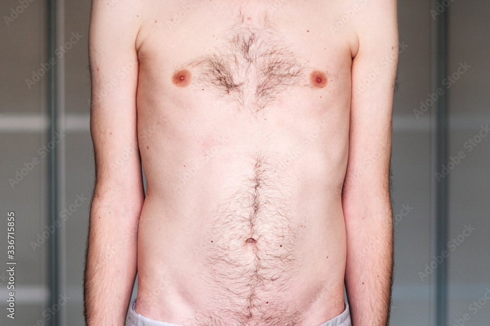 Fototapeta premium muscular dystrophy of a man with a protrusion of the abdomen