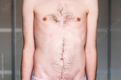 muscular dystrophy of a man with a protrusion of the abdomen