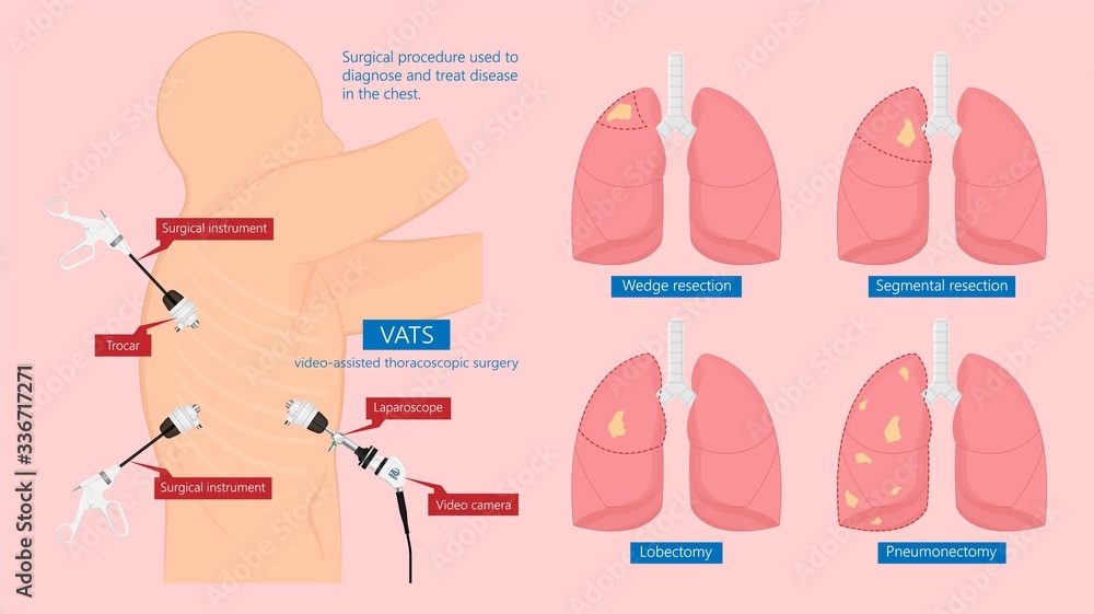 Vetor de VATS lung cancer treatment sub pus tap cell open tube COPD
