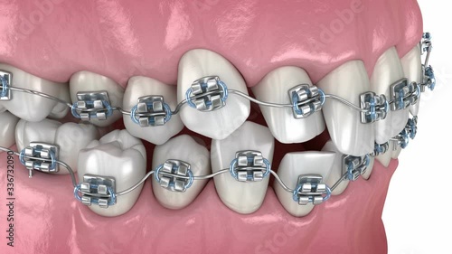 Abnormal teeth position and correction with metal braces tretament. Medically accurate dental 3D animation