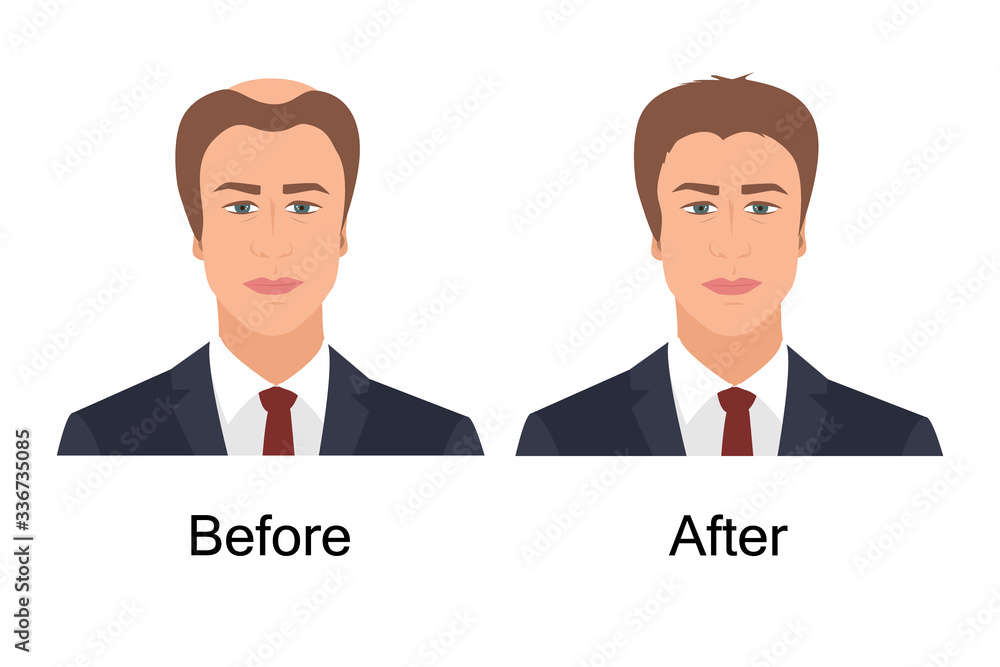 Man with alopecia before and after hair treatment and transplantation. Male baldness problem solution. Health and beauty concept for diagnostic centers and clinics. Vector illustration. Man with alopecia before and after hair treatment and transplantation. Male baldness problem solution. Health and beauty concept for diagnostic centers and clinics. Vector illustration.