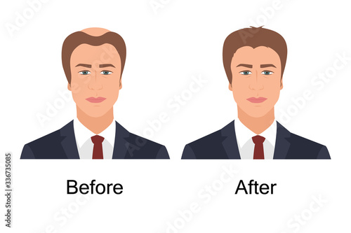 Man with alopecia before and after hair treatment and transplantation. Male baldness problem solution. Health and beauty concept for diagnostic centers and clinics. Vector illustration.