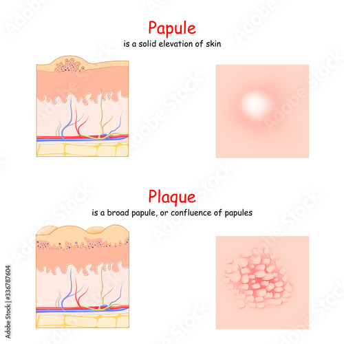 Skin lesion. Papule and Plaque. side and top view. Cross section of the human skin.