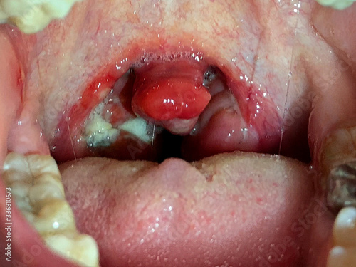 chronic tonsillitis. damage to the mucous membranes in the oral cavity. photo