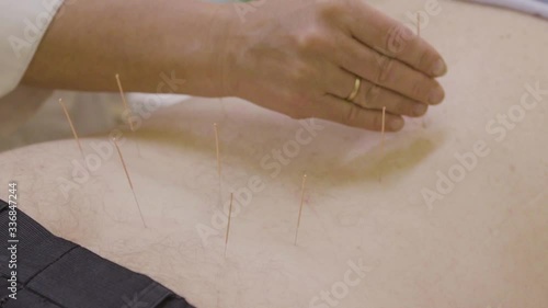 The doctor sticks needles into the girl's body on the acupuncture