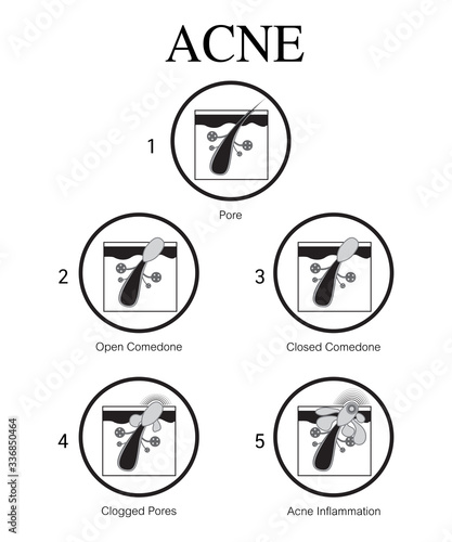Acne,stages of development,healthy skin,vector design