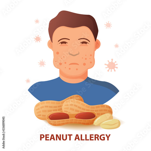 Nut allergy symptoms problem .Swollen man character.Anaphylaxis person concept.Allergic reaction to peanuts.Flat illustration vector.