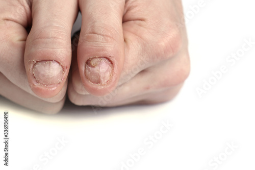 Man nail damage. Bitten nails. Man manicure. Nail plate problems. Man hands . Isolated on a white background.