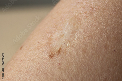 Картината върху платно BCG vaccination mark on a woman's arm