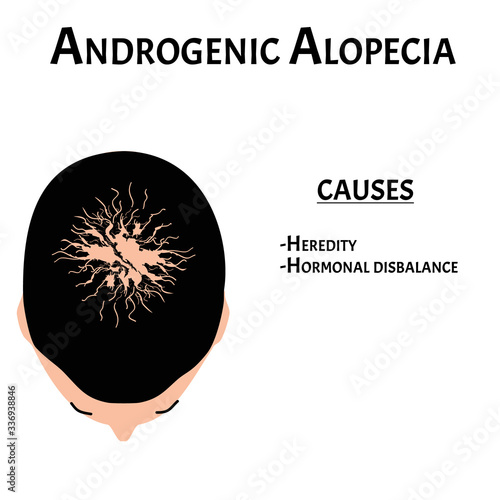 Alopecia hair. Baldness of hair on the head. Androgenic alopecia causes. Infographics. Vector illustration on isolated background.