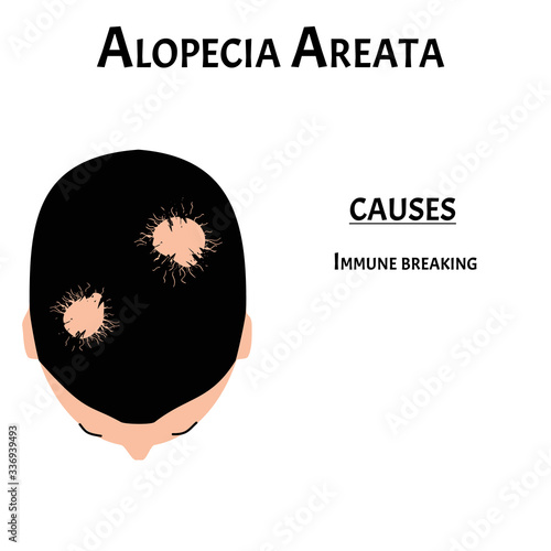 Alopecia hair. Baldness of hair on the head. Alopecia areata causes. Infographics. Vector illustration on isolated background.