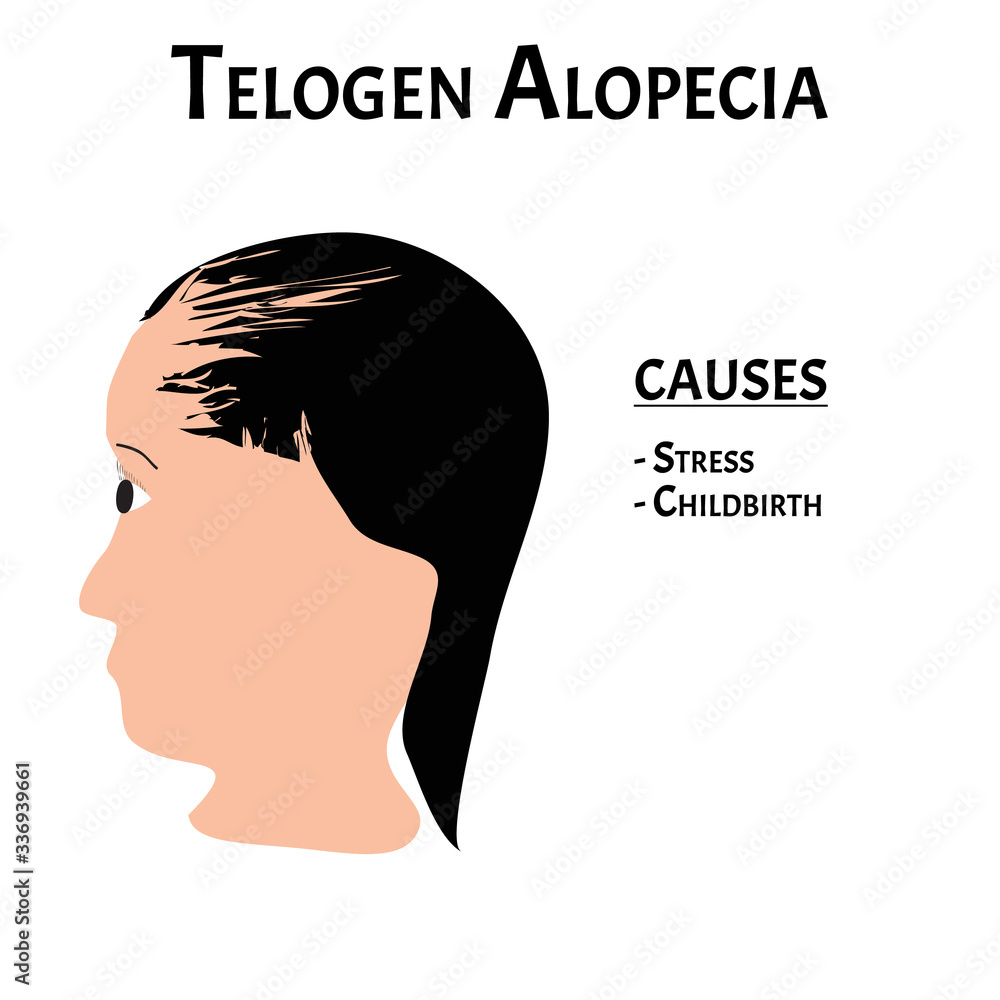 Alopecia hair. Baldness of hair on the head. Telogen Alopecia causes. Infographics. Vector illustration on isolated background.