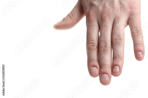 Man nail damage. Bitten nails. Man manicure. Nail plate problems. Man hands . Isolated on a white background. photo