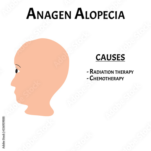 Alopecia hair. Baldness of hair on the head. Anagen Alopecia causes. Infographics. Vector illustration on isolated background.