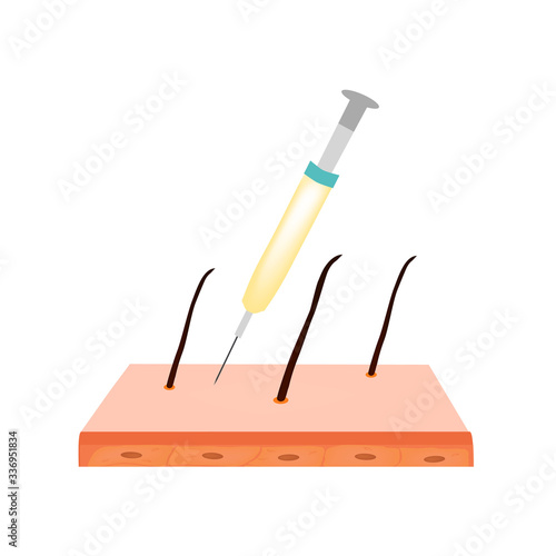 Treatment of alopecia. Bald spot, baldness, Alopecia mesotherapy. Infographics. Vector illustration on isolated background.